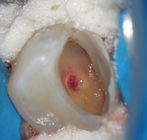 Pain control in endodontics